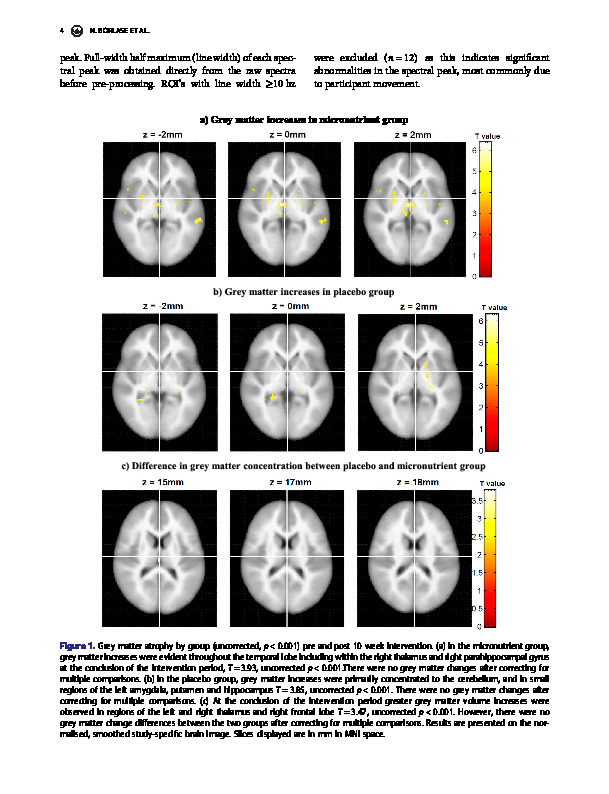 Download Resting-state networks and neurometabolites in children with ADHD after 10 weeks of treatment with micronutrients: results of a randomised placebo-controlled trial.